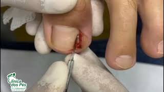 Encravada e com granuloma! @podologoleonardovieira #ingrown_toenail #unhaencravada