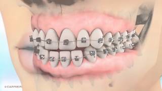 Carriere® Motion™ Appliance for Class III Patient Education! | Braces Orthodontist in Madison, GA