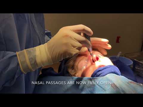 Video thumbnail: Results of septoplasty
