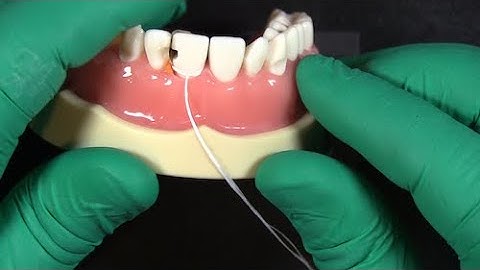 Use this floss trick to seal your matrix bands for anterior restorations