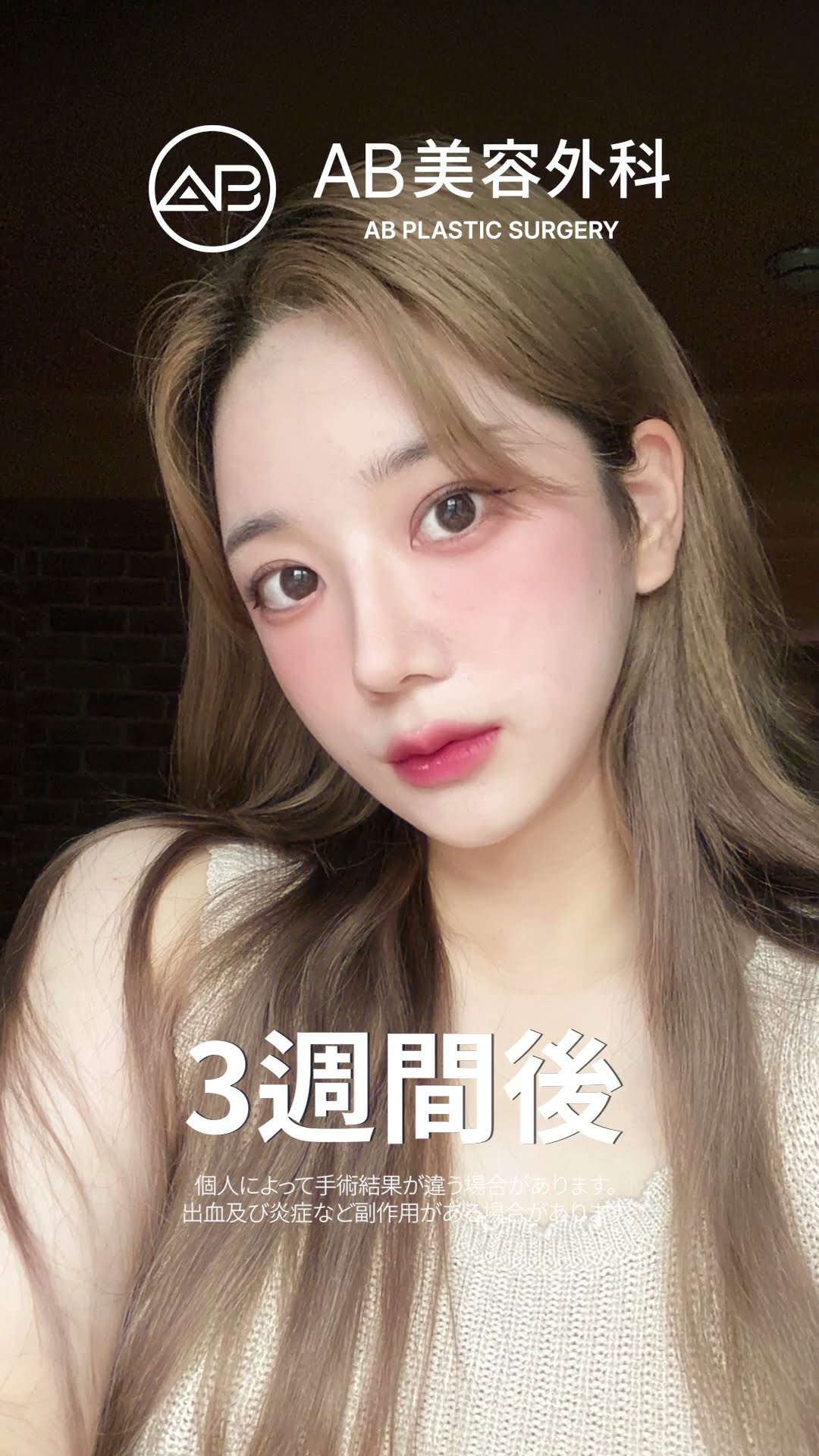 奇跡のビフォーアフター！整形で手に入れた新しい美！ #韓国整形 #美容