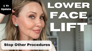 Lower Facelift: My 1 Year Review (lets get real)