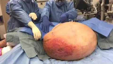 Surgeons remove 140-pound tumor from 71-year-old grandmother - DayDayNews