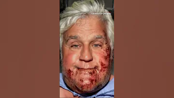 Jay Leno shows off his new ear after accident