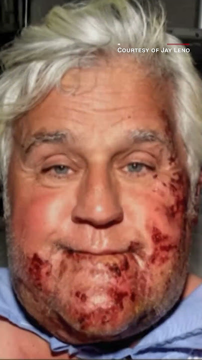 Jay Leno shows off his new ear after accident