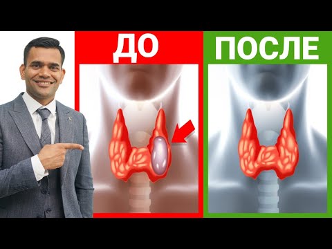 Видео: Простые способы уменьшить узелки щитовидной железы