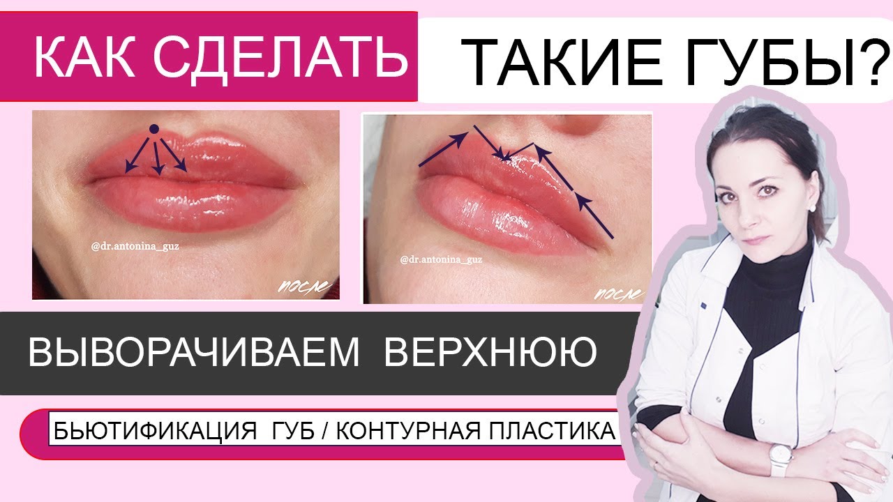 Техника введения филлера