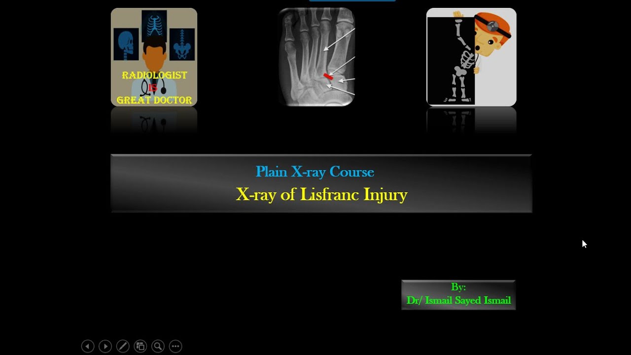 X ray of Lisfranc injury For Radiology Residents