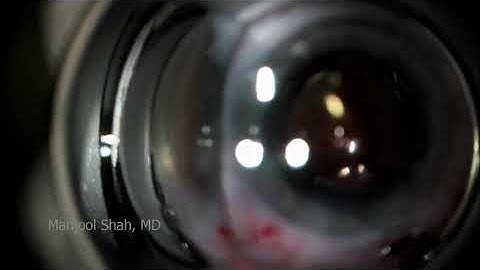 XEN® Implantation Procedure