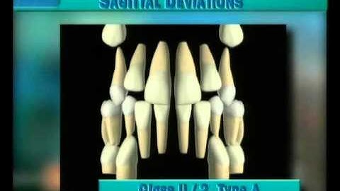 Clip 37: Frontal View of Development of Class II/2 Type A