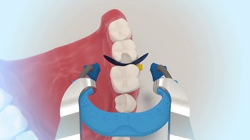 myQuickmat Classico kit - Polydentia