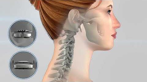 Mobi C vs  fusion movement in neck 1 short