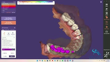Exocad Tutorial: Long Temporary Bridge Design Made Easy!