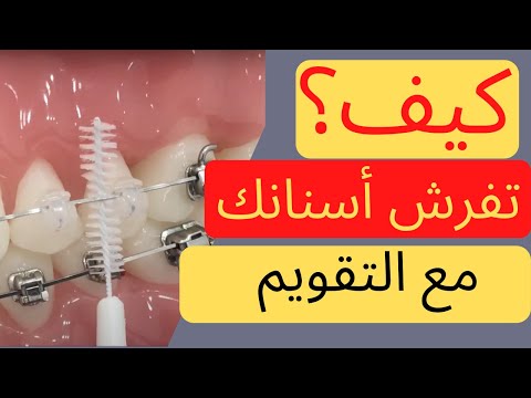أسهل طريقة لتفريش الأسنان مع التقويم الدكتور محمد صادقلي
