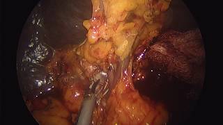 Laparoscopic splenectomy - Massive Splenomegaly (fully narrated)