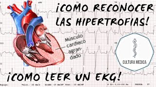 COMO RECONOCER LA HIPERTROFIA EN EL EKG/ECG | EKG PARTE 6| by CULTURA MÉDICA 3,525 views 3 years ago 8 minutes, 6 seconds