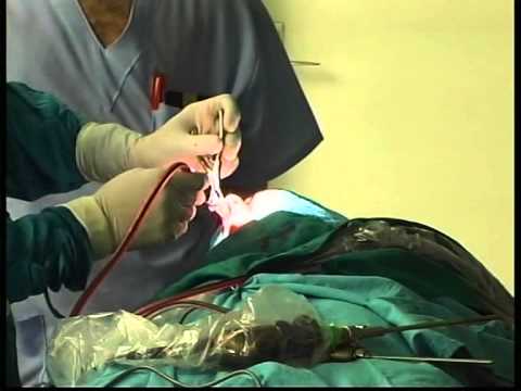 Live Surgery Course Of The Nose And Paranasal Sinuses - Operation 1 (part 3)