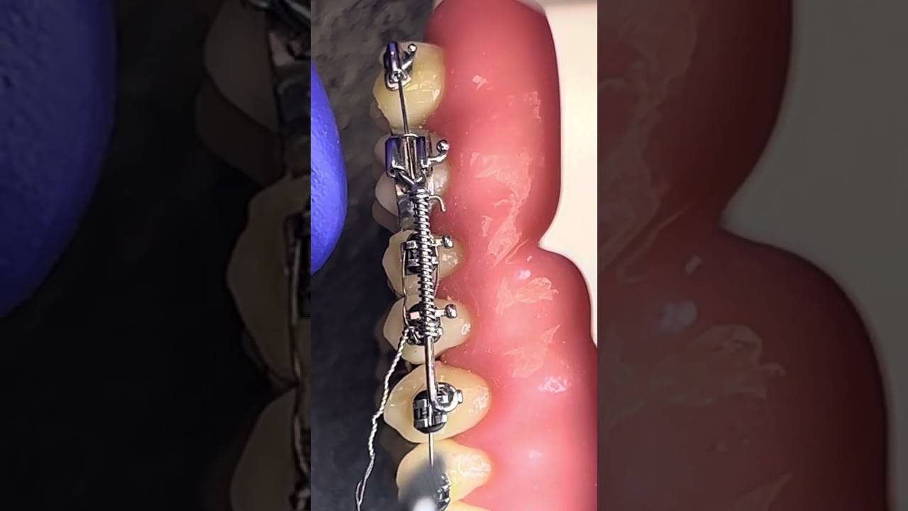 Distalização com Jones Jig ancorado em botão de Nance. Dica 82 a 23/03/2025