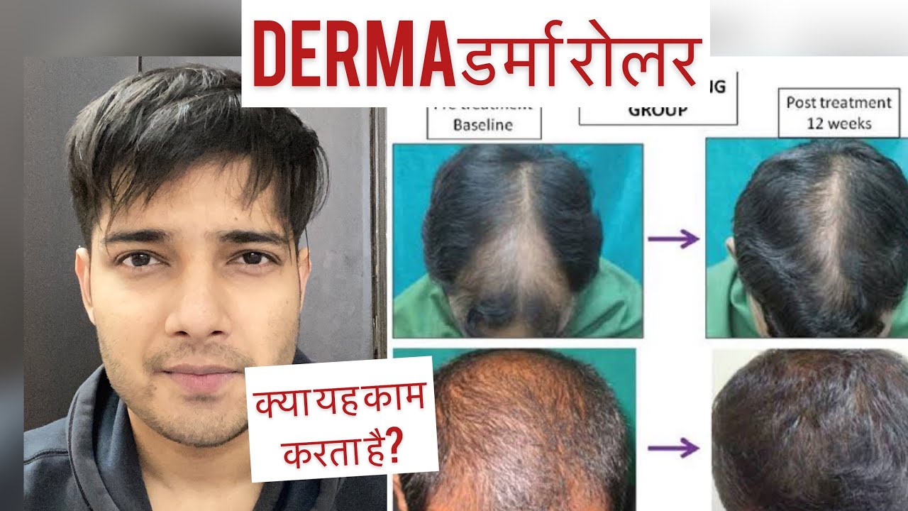 Side Effects of Derma Roller  DermaRoller Side Effects  How to use Derma  Roller  YouTube