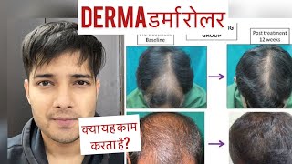 डर्मा रोलर|Dermaroller RESULT| Dermaroller For Hair growth| Side effects| Hairfall| Hairloss| Hindi