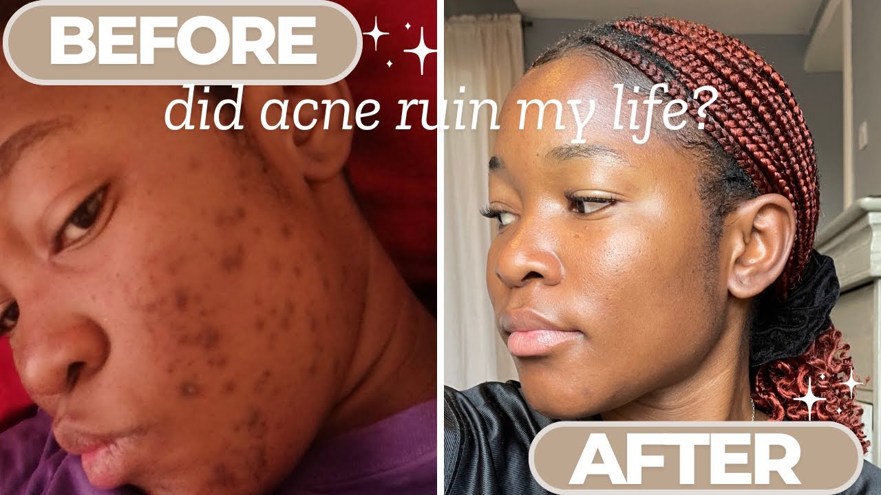 How I cleared my acne using these 3 products… - YouTube