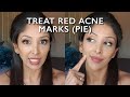 Red Acne Scars DOCTOR V |BROWN/DARK SOC| PIE| TREAT Post Inflammatory Erythema marks | ACNE CURE|