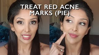 Red Acne Scars DOCTOR V |BROWN/DARK SOC| PIE| TREAT Post Inflammatory Erythema marks | ACNE CURE|