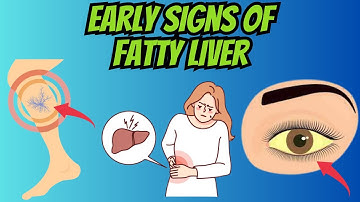 The Silent Killer: Uncovering the Hidden Early Signs of Fatty Liver Disease