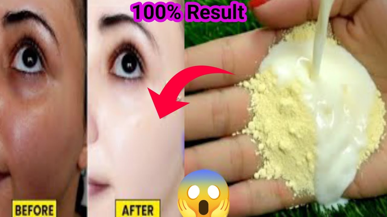 ना पार्लर ना क्रीम घरगुती उपायाने वांग कायमचा जाईल😱 चेहरा गोरा होईल | viral besan facepack 