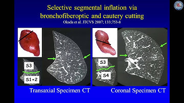 [Keynote Lecture] Open, thoracoscopic and robotic segmentectomy for lung cancer