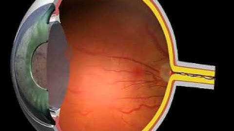 Glaucoma
