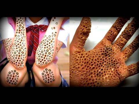 5 Самых Страшных Болезней Мира ч2