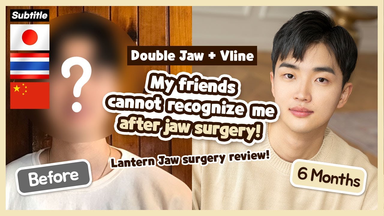 SUB [VLOG Double Jaw] My friends cannot recognize me after jaw surgery! Lantern Jaw surgery review!