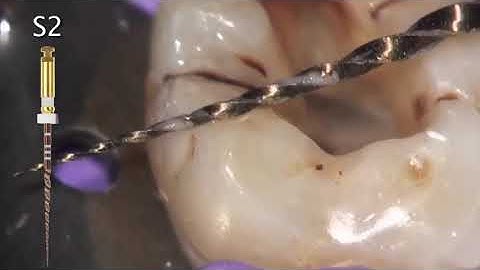 Dentsply ProTaper Gold Rotory Files - How To use - DENTBEAR