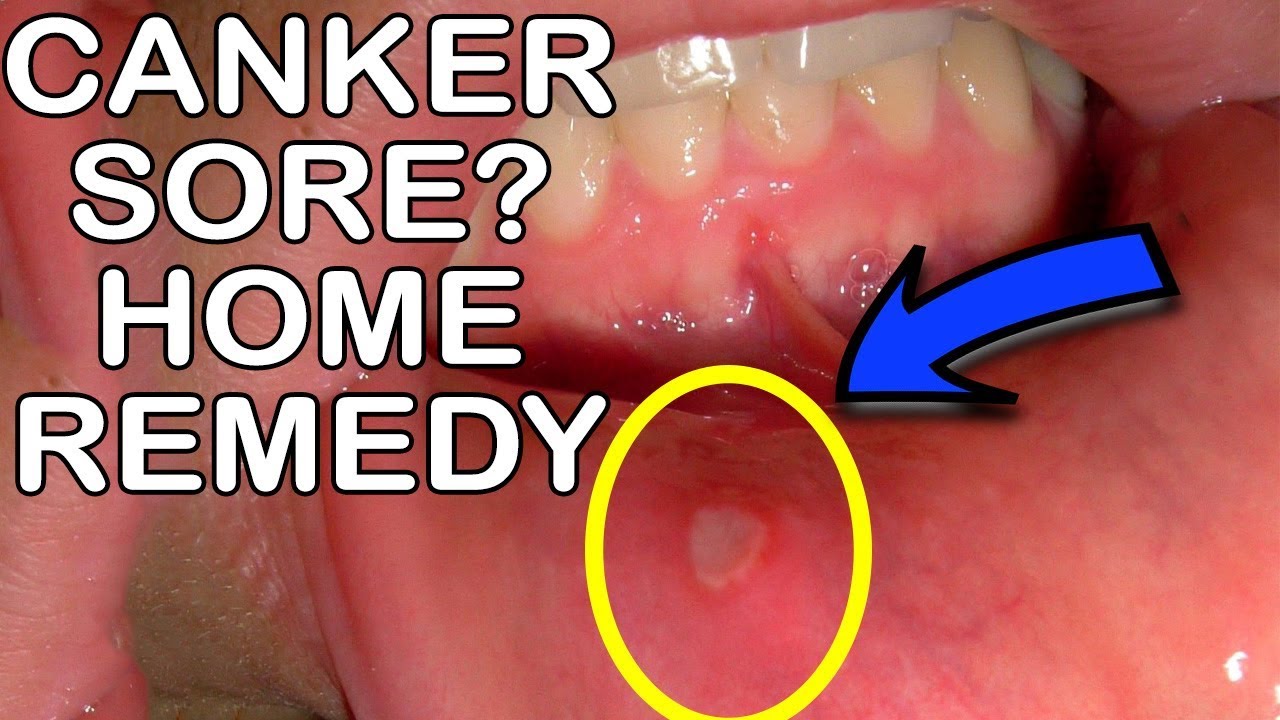 How To Get Rid Of Canker Sores: Mouth Ulcer Home Remedy - YouTube