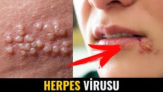 Herpes Vi̇rusu - Simptomları Yaranma Səbəbi