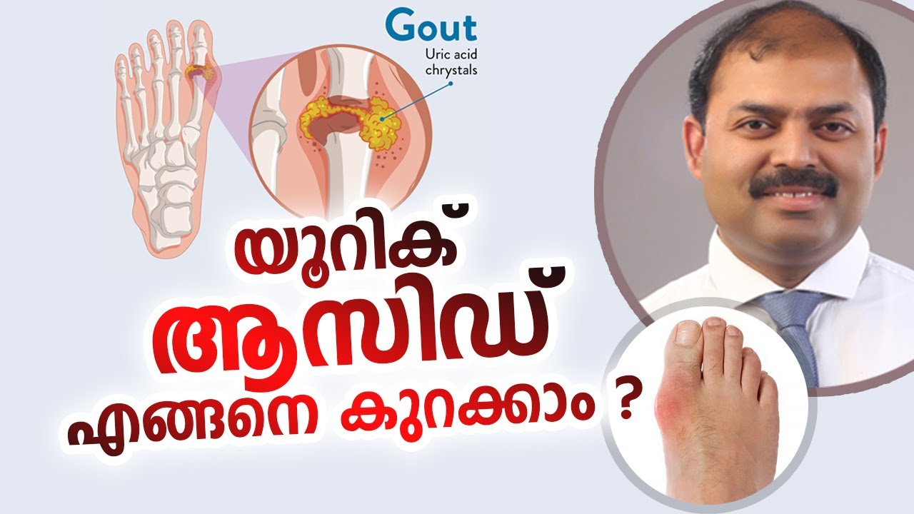 യൂറിക് ആസിഡ് എങ്ങനെ കുറക്കാം | Dr Anoof | Arogyam