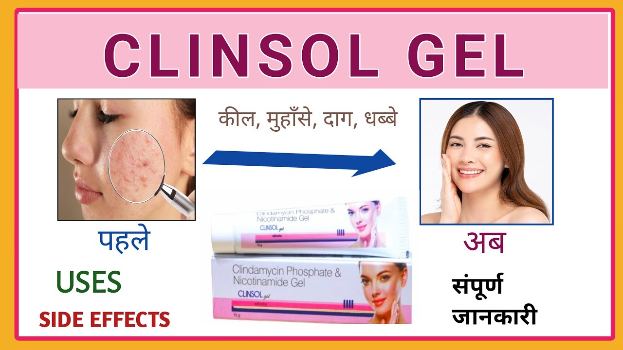 Clinsol gel for pimples | Acne | clinsol gel ke fayade and nukshan ...