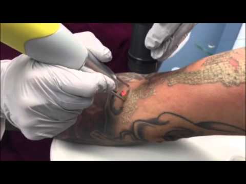 laser tattoo removal full sleeve skin deep laser services burke laser tattoo removal full sleeve skin deep laser services burke