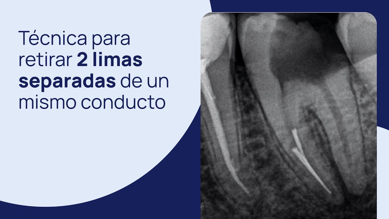 Técnica paso a paso para retirar 2 limas separadas de un mismo conducto
