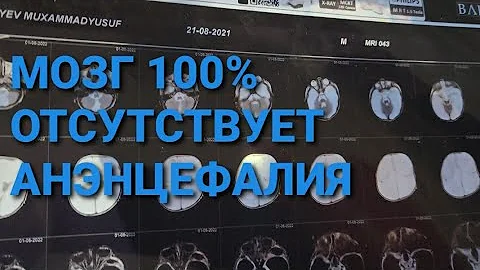 МОЗГ 100% ОТСУТСТВУЕТ С ДИАГНОЗОМ ГИДРО АНЭНЦЕФАЛИЯ