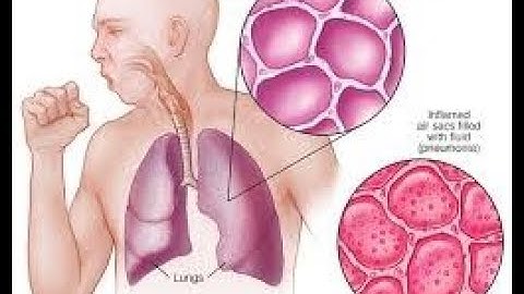 Pneumonia X-Ray Detection /Prediction Using Keras and Tensorflow API Deep Learning