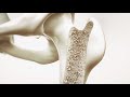 Osteoporose – die versteckte Pandemie?