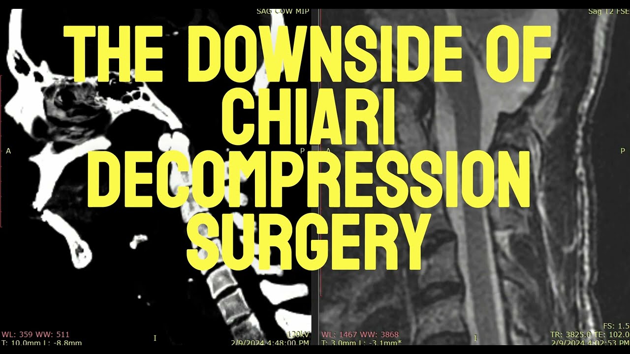 What is the Downside of Chiari Surgery?
