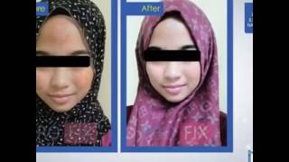 Ubat Muka Berlubang Pertama Di Malaysia