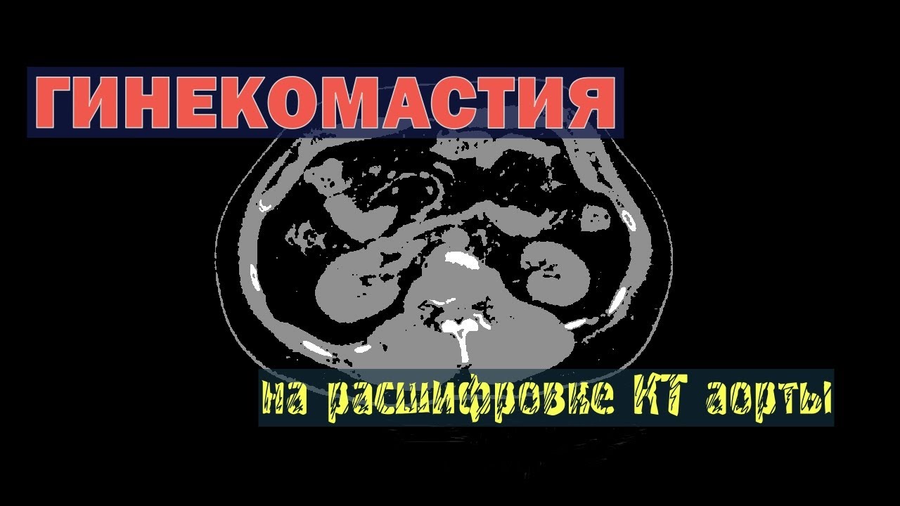 ГИНЕКОМАСТИЯ у мужчин на расшифровке КТ ангиография брюшной аорты ...
