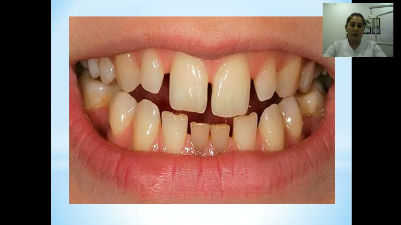 Tish jag' tizimi anomaliyalari va deformatsiyalarning profilaktikasida ortodontik yondoshuvning aham