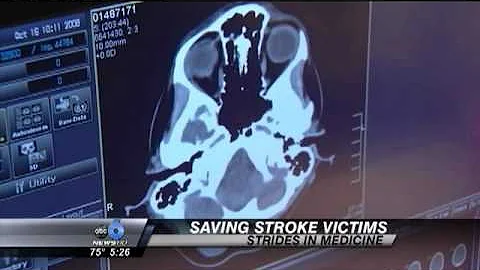 tPA Administration for Stroke Patients