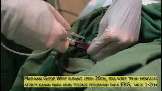 Central Venous Catheter Subclavia Approach