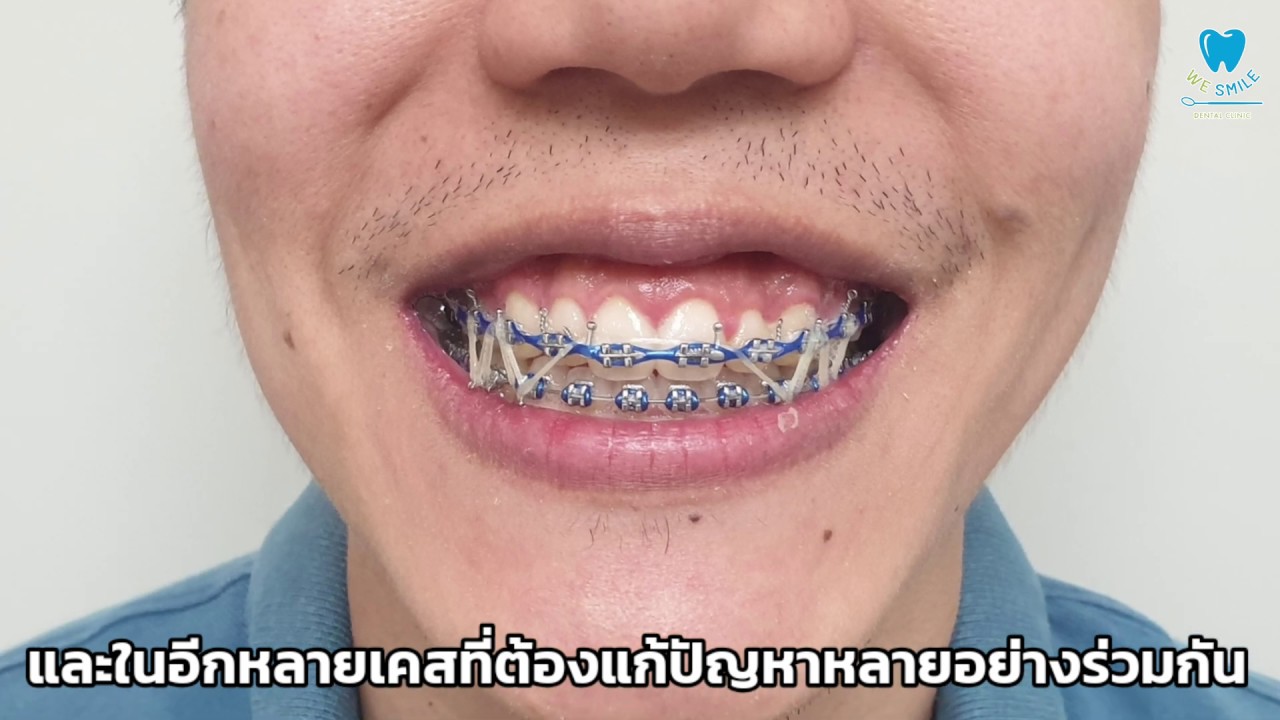 ยางดึงฟัน || ทุกสิ่งต้องรู้เกี่ยวกับยางดึงฟัน ครบจบใน 3 นาที - Youtube
